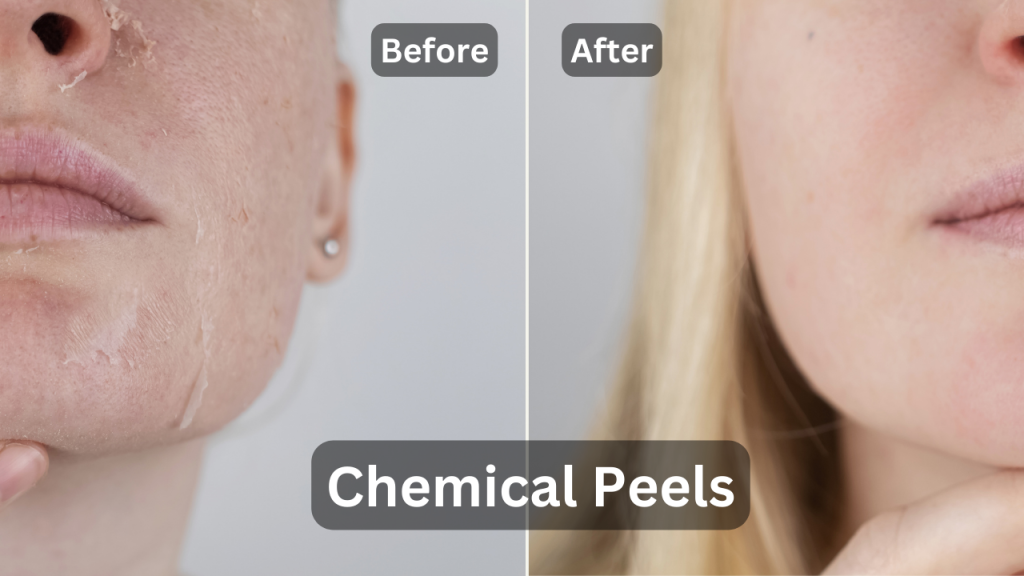 Chemical peels