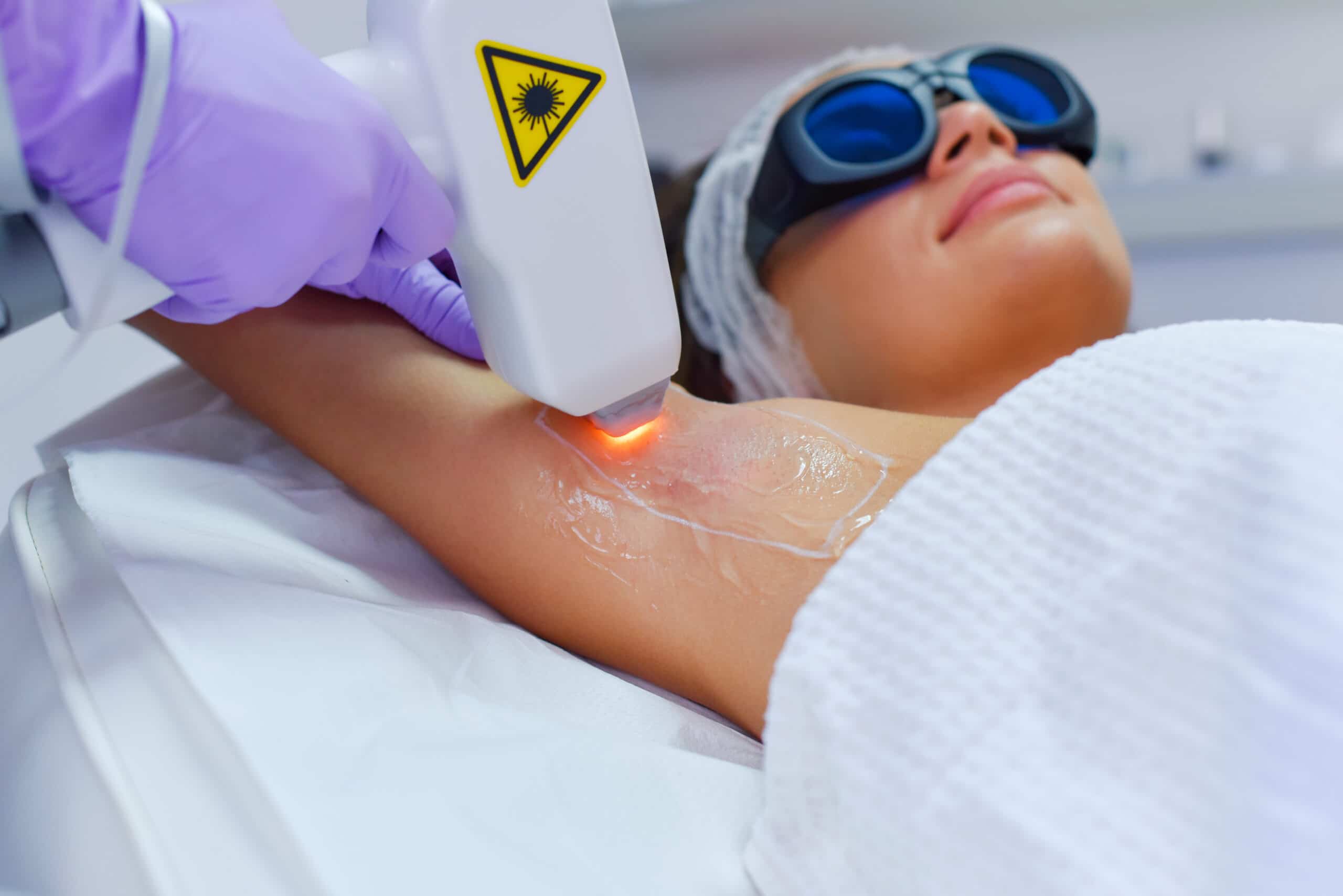 Laser hair reduction